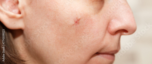 Real scar on the young woman face, scar on the cheek after a mole removal surgery. Scar after plastic surgery