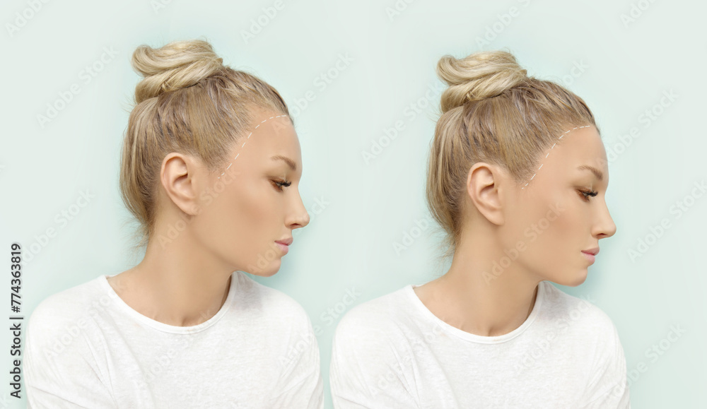 Thinning hair and hair loss,female pattern baldness,Hair transplant Thinning hair and hair loss,female pattern baldness,Hair transplant
