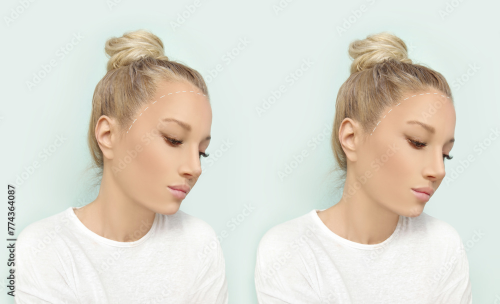 Thinning hair and hair loss,female pattern baldness,Hair transplant Thinning hair and hair loss,female pattern baldness,Hair transplant