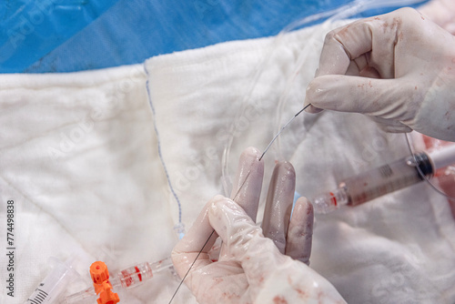 Interventional cardiology. Surgeon doctor at operation. Stent and catheter for implantation into blood vessels with an empty and filled balloon. photo