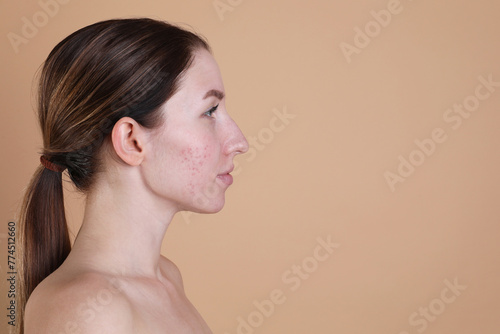Young woman with acne problem on beige background. Space for text