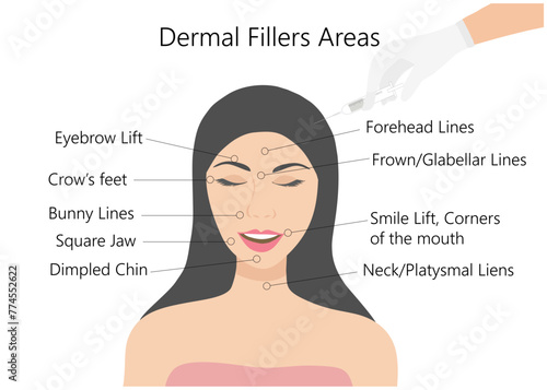 Dermal filler and botox injections areas. Woman face with doctor hands in gloves with syringe. Beauty lifting anti-aging treatment vector illustration.