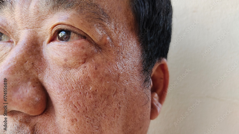 portrait the wrinkle and Flabby skin, blackhead and acne, blemish and ...