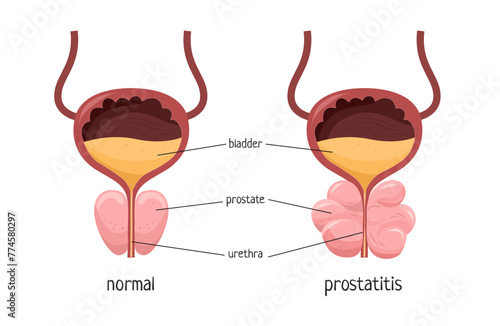 Vector illustration of a healthy prostate and prostatitis. Medical poster.
