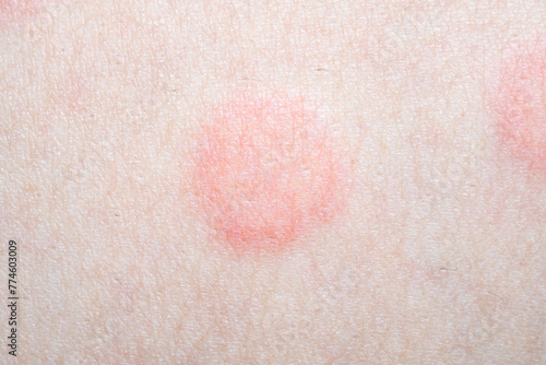 Skin allergy rash dermatitis texture close up photo