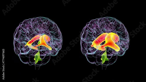 Animation showing enlarged lateral ventricles (hydrocephalus, right) compared to normal lateral ventricles (left) of the brain photo