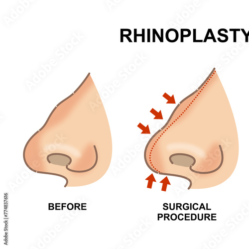 Rhinoplasty nose surgery before and after the procedure