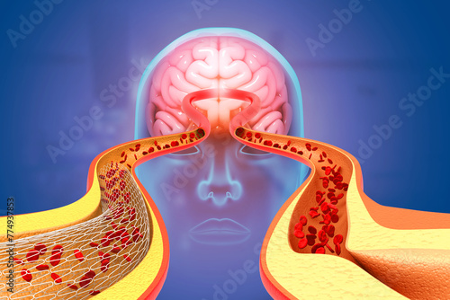 Stroke, stent angioplasty, blood stream, Damaged brain. 3d illustration