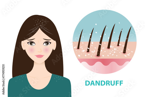 Infographic of woman and dandruff icon vector illustration. The woman is worried about white dry flakes on hair and shoulder. Icon of dandruff, scaly scalp in hair. Hair care and problem concept.