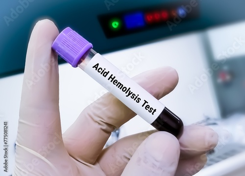 Blood sample for Acid Hemolysis test, to diagnose paroxysmal nocturnal hemoglobinuria (PNH). HAM'S Test.