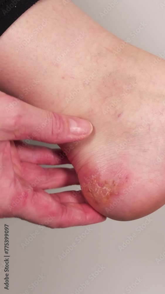 Woman rubbing her heel with her finger. Huge wound on female foot after several confluent blisters of eczema. Acute psoriasis, chemical irritation, allergic reaction, dermatological disease on foot. Woman rubbing her heel with her finger. Huge wound on female foot after several confluent blisters of eczema. Acute psoriasis, chemical irritation, allergic reaction, dermatological disease on foot.
