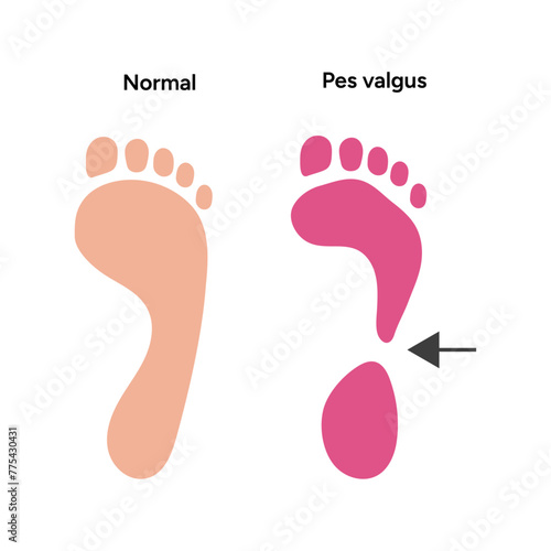 Normal and pes valgus foot 