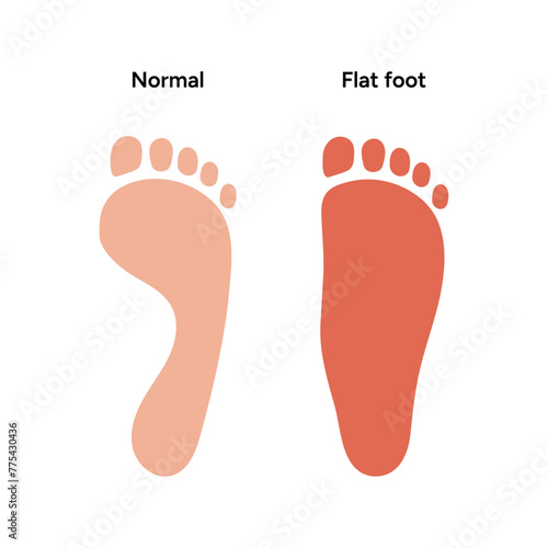 Normal and flat foot