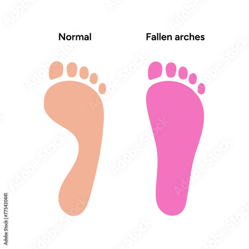 Normal and fallen arches