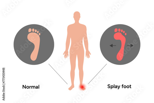 Normal and splay foot