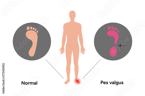 Normal and pes valgus foot