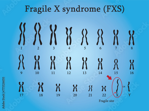 The Karyotype of Fragile X syndrome (FXS) is a genetic disorder of fragile on chromosome x caused by malfunction of gene FMR-1. photo