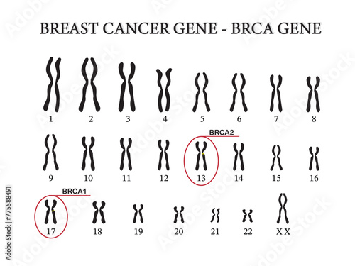 BRCA genes expression in breast cancer are located on chromosomes. 