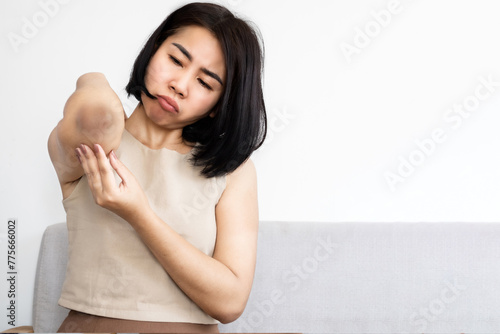 Photography Asian woman having problem with skin condition dark elbow