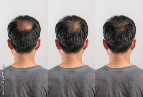 back side of a man with hair loss problem. comparing before and after treatment with thinning or falling hair and noticeably thicker hair and healthier photo