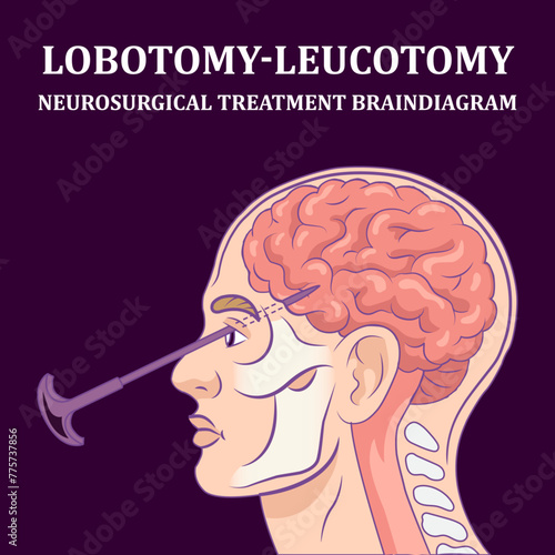 Brain Diagram: Lobotomy leucotomy neurosurgical treatment in brain diagram schematic raster illustration. Medical science educational illustration
