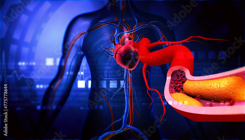 Cholesterol in human heart, Clogged blood vessels,3d illustration. photo