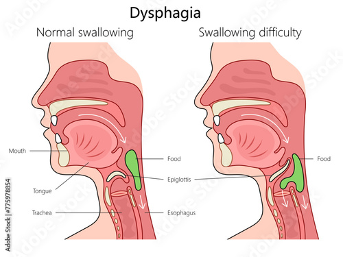 dysphagia swallowing difficulty and normal swallowing with labeled anatomy structure vertebral column diagram hand drawn schematic vector illustration. Medical science educational illustration