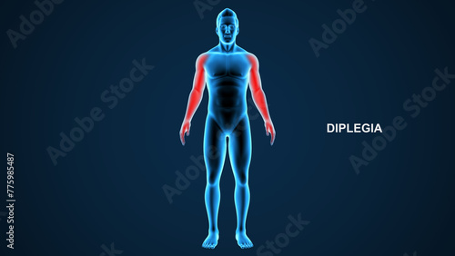 Diplegia type paralysis 3d Illustration photo