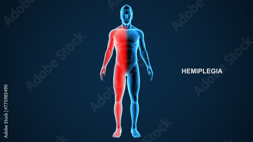 Hemiplegia type paralysis 3d Illustration