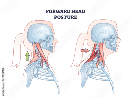 Forward head posture compared with healthy neck position outline diagram, transparent background. Educational scheme with turtle neck condition and muscular system illustration.