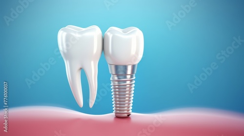 Realistic dental implant on a blue background 