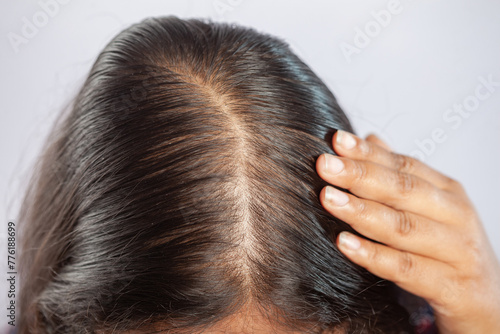 adult women suffering from hair fall showing bald head scalp photo