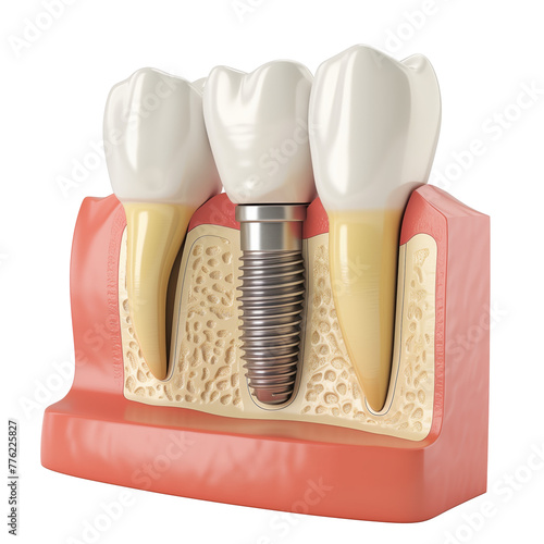 Detailed medical illustration of a dental implant in the jawbone isolated on transparent background photo