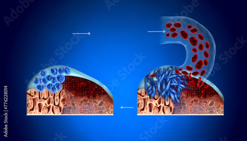 Breast Adenosis and Sclerosing Adenosis Illustration. Visual representation of adenosis and its progression to sclerosing adenosis in the breast, highlighting glandular overgrowth. photo