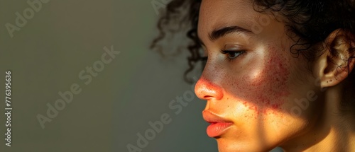 Closeup of woman with red facial rash from Lupus seeking treatment. Concept Lupus Awareness, Skin Health, Red Facial Rash, Medical Treatment, Closeup Portrait photo