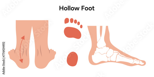 Hollow foot deformity 