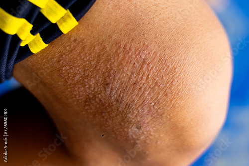 Itchy rash from an allergic reaction to your own sweat
