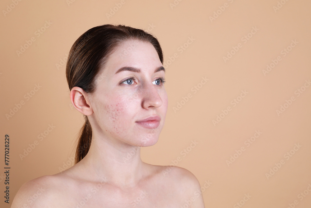 Young woman with acne problem on beige background. Space for text Young woman with acne problem on beige background. Space for text