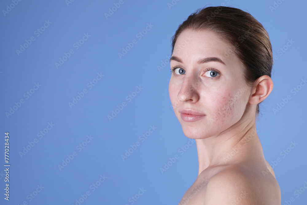 Young woman with acne problem on blue background. Space for text Young woman with acne problem on blue background. Space for text