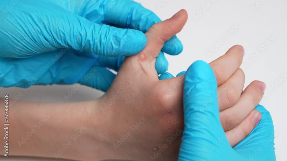 Dermatologist wearing medical gloves examines child hand with viral