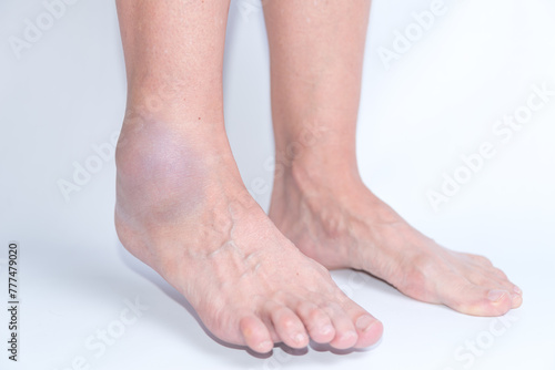 ankle sprain, joint inflammation, pain, bruise, foot sprain © Jezabel
