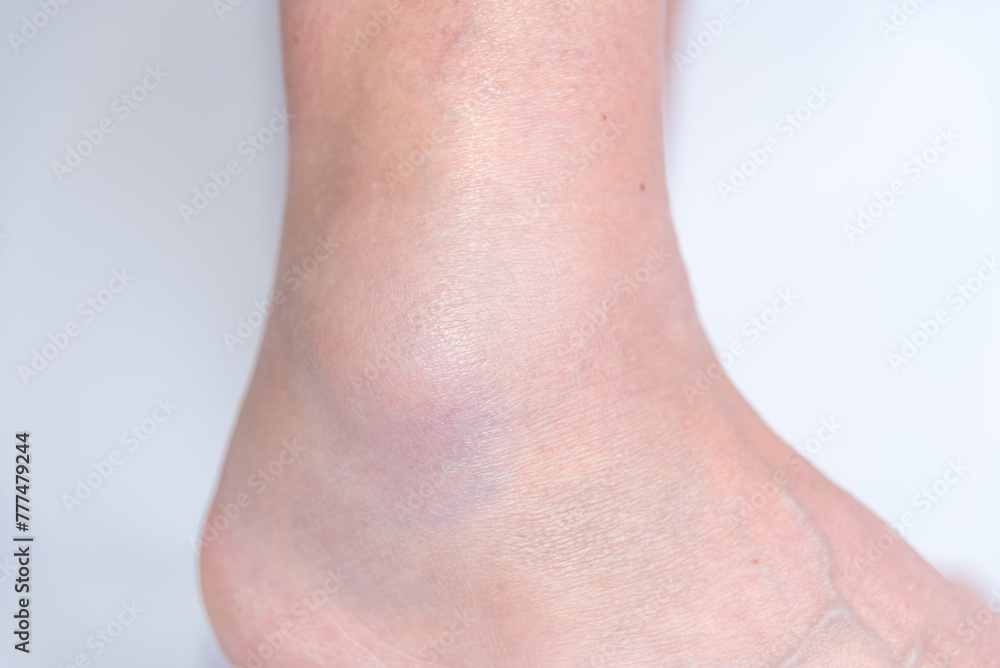 close up of sprained ankle, joint inflammation, pain, bruise close up of sprained ankle, joint inflammation, pain, bruise
