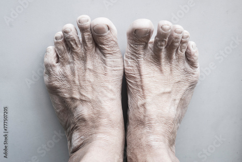The skin is dry and rough on the feet of elderly people.