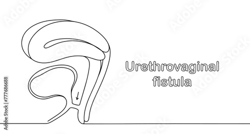 Urethrovaginal fistula