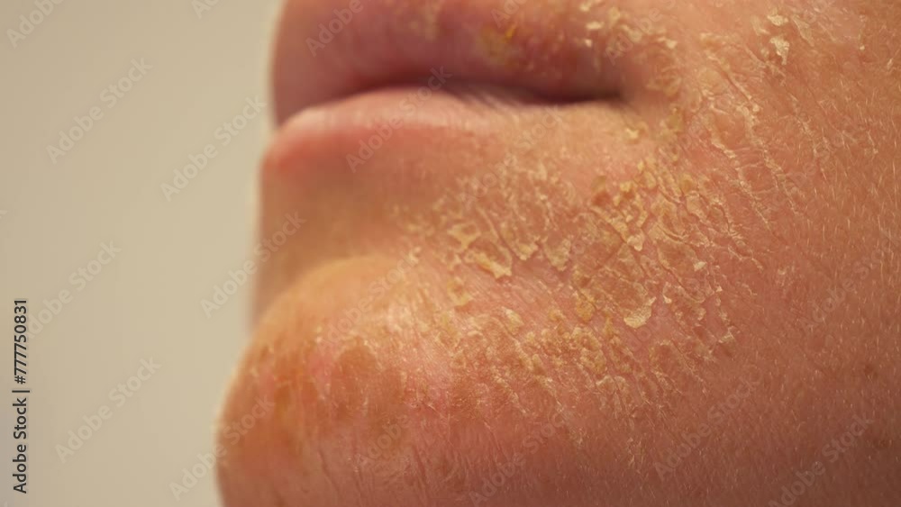 CLOSE UP, DOF: Seriously damaged epidermis of skin on the face of an unrecognizable young woman. Harmful consequences of summer sunbathing, which can gradually lead to the development of skin cancer. CLOSE UP, DOF: Seriously damaged epidermis of skin on the face of an unrecognizable young woman. Harmful consequences of summer sunbathing, which can gradually lead to the development of skin cancer.