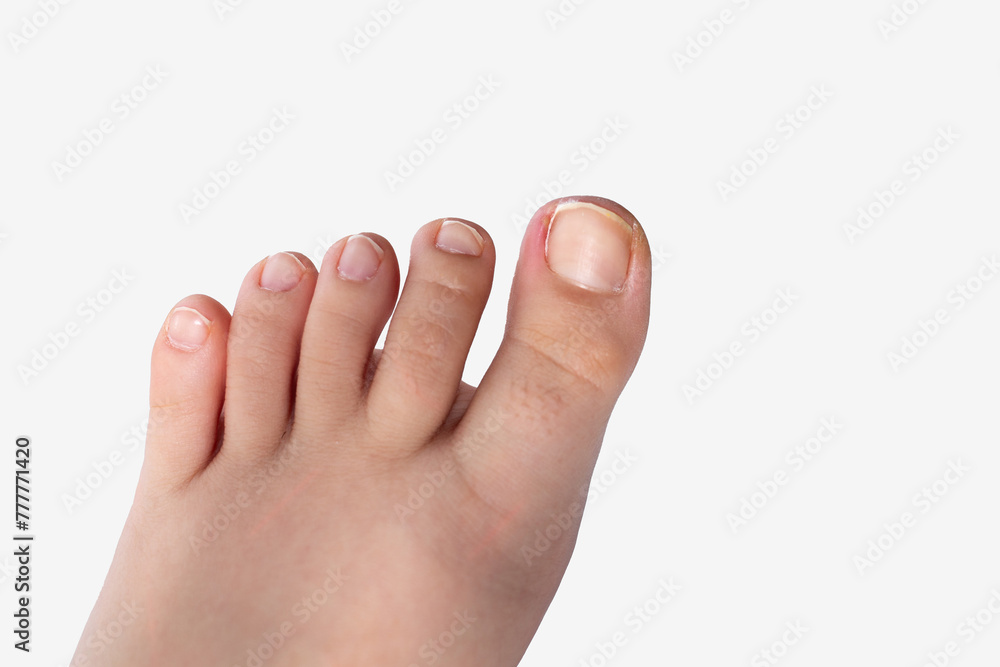 ingrown toenail, view after tamponade - obrazy, fototapety, plakaty 