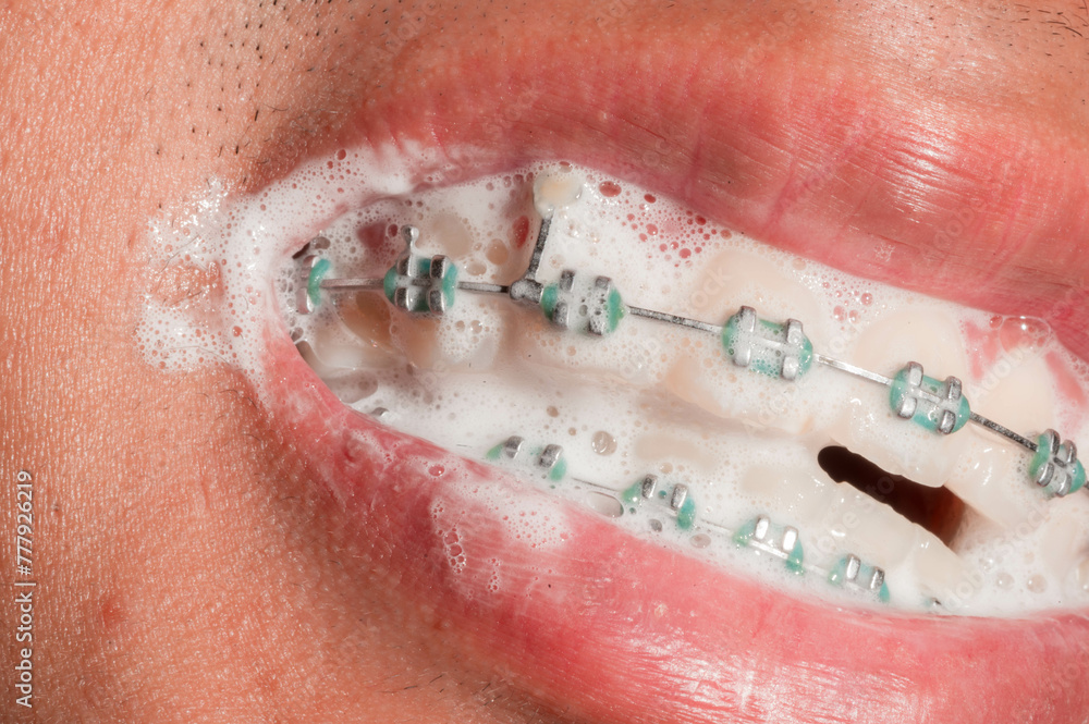 Fototapeta premium Orthodontic Care: Brushing and Cleaning Braces