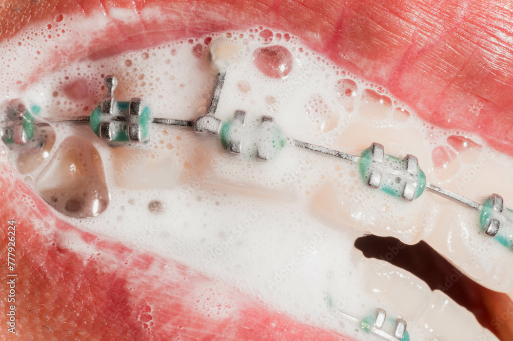 Fototapeta premium Orthodontic Care: Brushing and Cleaning Braces