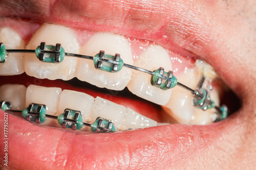 Orthodontic Care: Brushing and Cleaning Braces