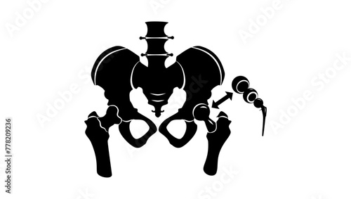 Hip replacement, black isolated silhouette